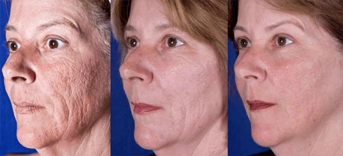 Ergebnis nach Laser-Gesichtshauterneuerung