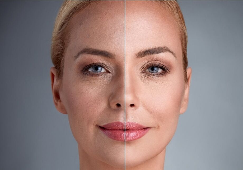 vor und nach der Laser-Gesichtsverjüngung