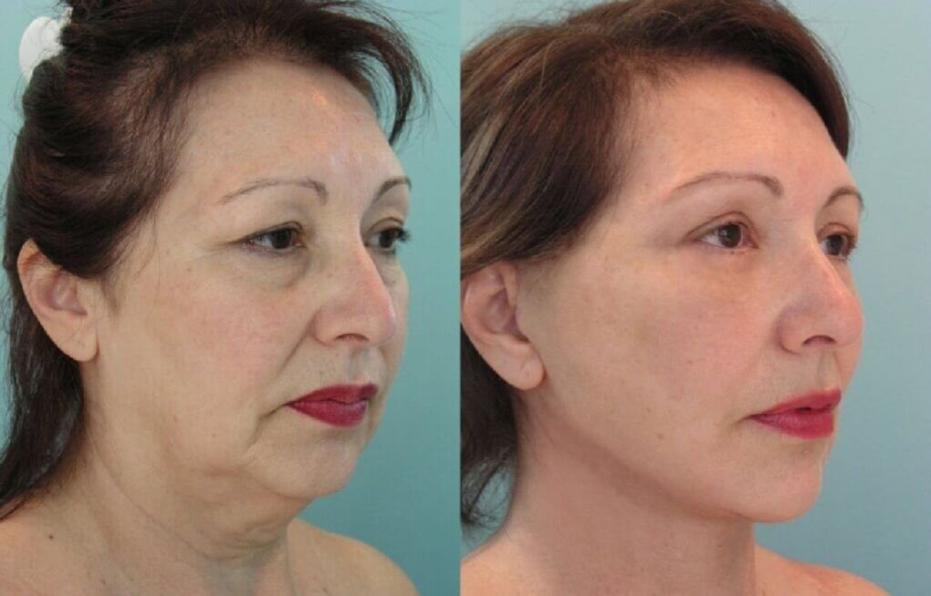 Foto vor und nach der Hautverjüngung